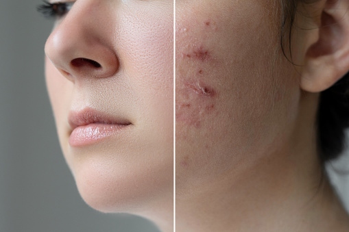 What You Can Do To Control Your Acne Breakouts￼