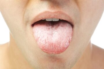 Causes of a dry mouth