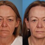 Blepharoplasty